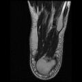 Anterior calcaneal process fracture (Radiopaedia 74654-85611 Axial T2 28).jpg