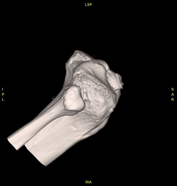 File:Anterior cruciate ligament avulsion fracture (Radiopaedia 58939-66194 VRT 5).jpg
