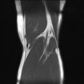 Anterior cruciate ligament full thickness tear (Radiopaedia 66268-75467 Coronal T1 20).jpg