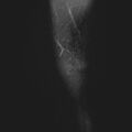 Anterior cruciate ligament tear - pediatric (Radiopaedia 62152-70260 Sagittal PD fat sat 2).jpg