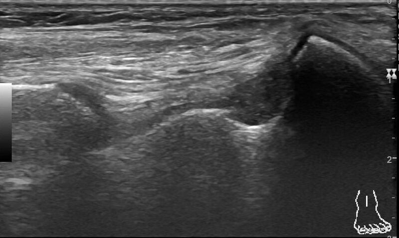 File:Anterior inferior tibiofibular ligament injury (Radiopaedia 65077-74073 Longitudinal 3).jpg