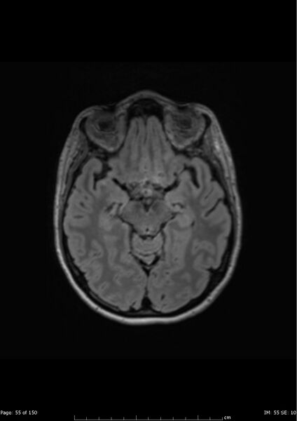File:Anterior temporal lobe perivascular space (Radiopaedia 40946-43650 Axial FLAIR 16).jpg