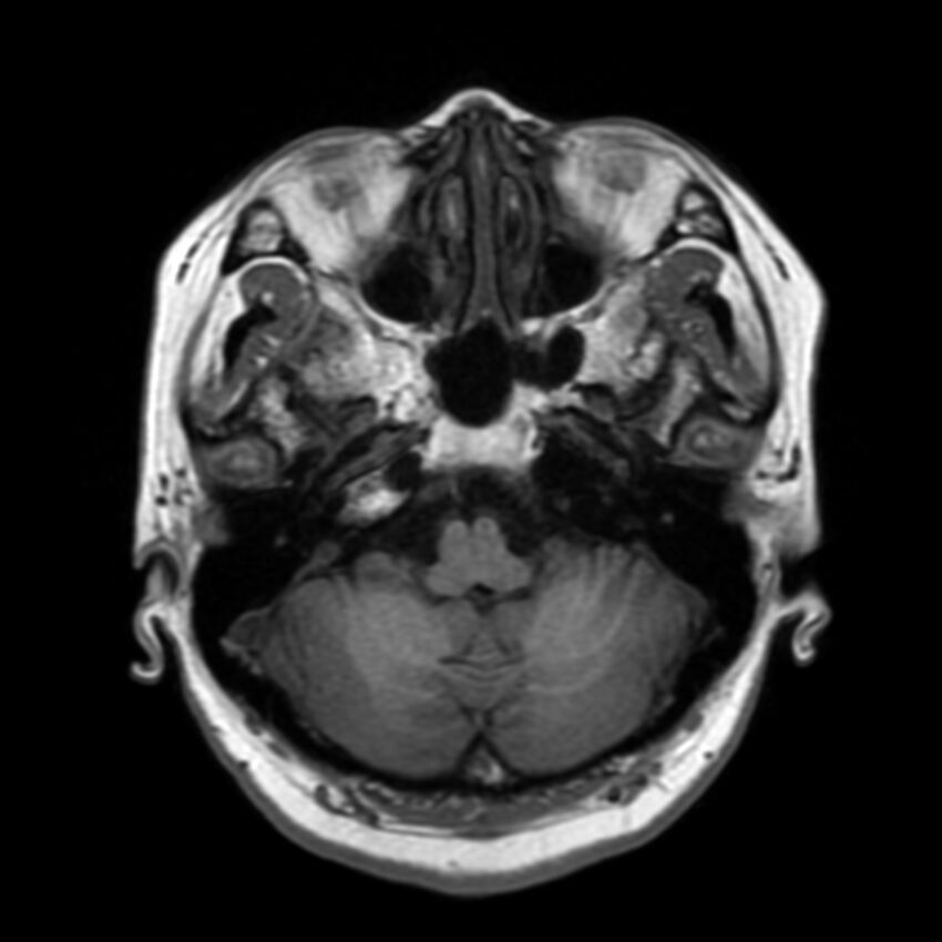 Anti-MOG encephalomyelitis (Radiopaedia 73831-84646 Axial T1 12).jpg
