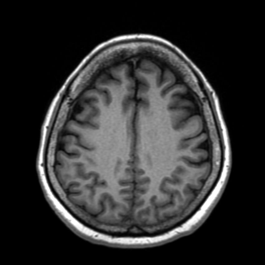 Anti-MOG encephalomyelitis (Radiopaedia 73831-84646 Axial T1 36).jpg