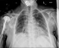 Antibiotic spacer (right shoulder) (Radiopaedia 27176).jpg