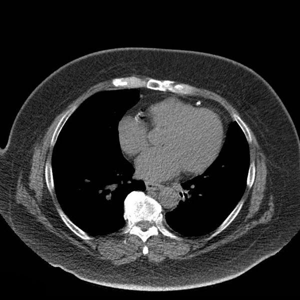 File:Aortic arch false aneurysm (Radiopaedia 14667-14587 Axial non-contrast 28).jpg