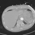 Aortic dissection - DeBakey type II (Radiopaedia 64302-73082 Axial lung window 56).png