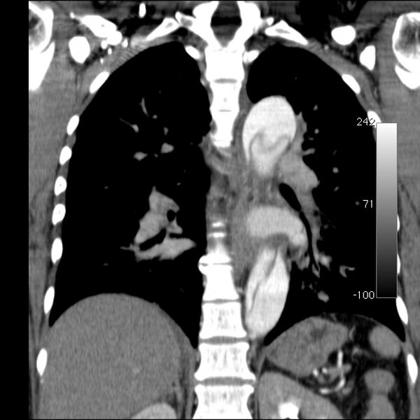 File:Aortic dissection - Stanford type A (Radiopaedia 29247-29659 B 40).jpg
