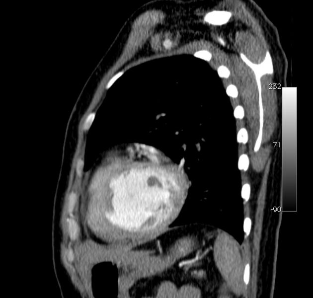 File:Aortic dissection - Stanford type A (Radiopaedia 29247-29659 C 7).jpg