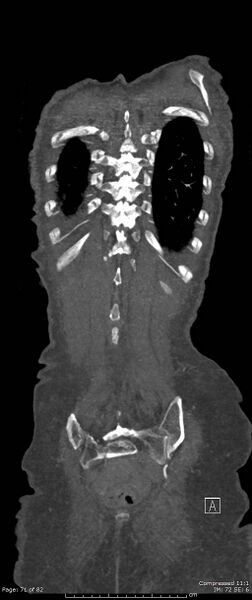 File:Aortic dissection with extension into aortic arch branches (Radiopaedia 64402-73204 A 71).jpg