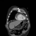 Aortic dissection with rupture into pericardium (Radiopaedia 12384-12647 B 3).jpg
