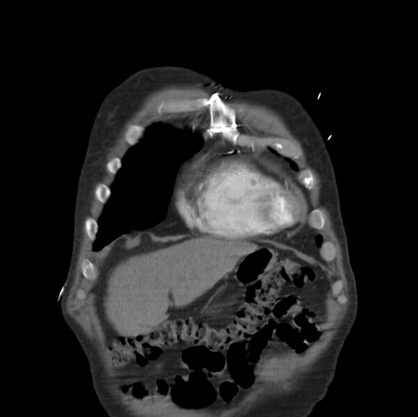 File:Aortic dissection with rupture into pericardium (Radiopaedia 12384-12647 B 3).jpg