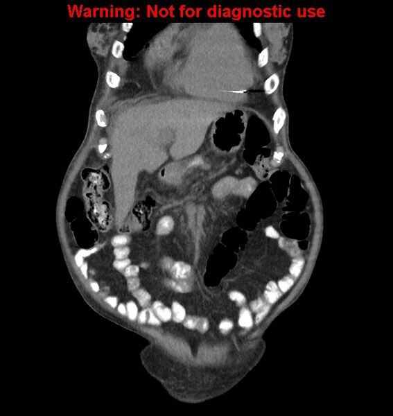 File:Aortic graft infection (Radiopaedia 44979-48907 non-contrast 12).jpg