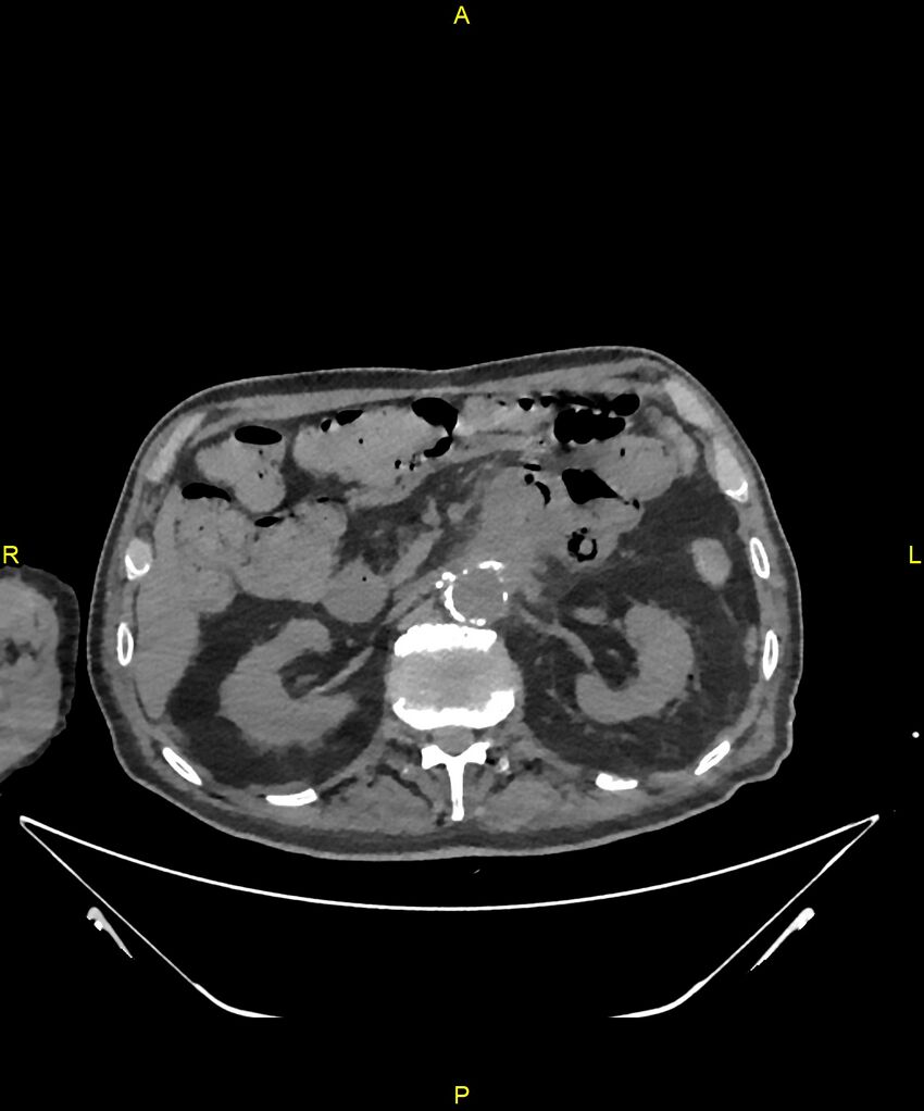 Aortoenteric fistula (Radiopaedia 84308-99603 Axial non-contrast 117).jpg