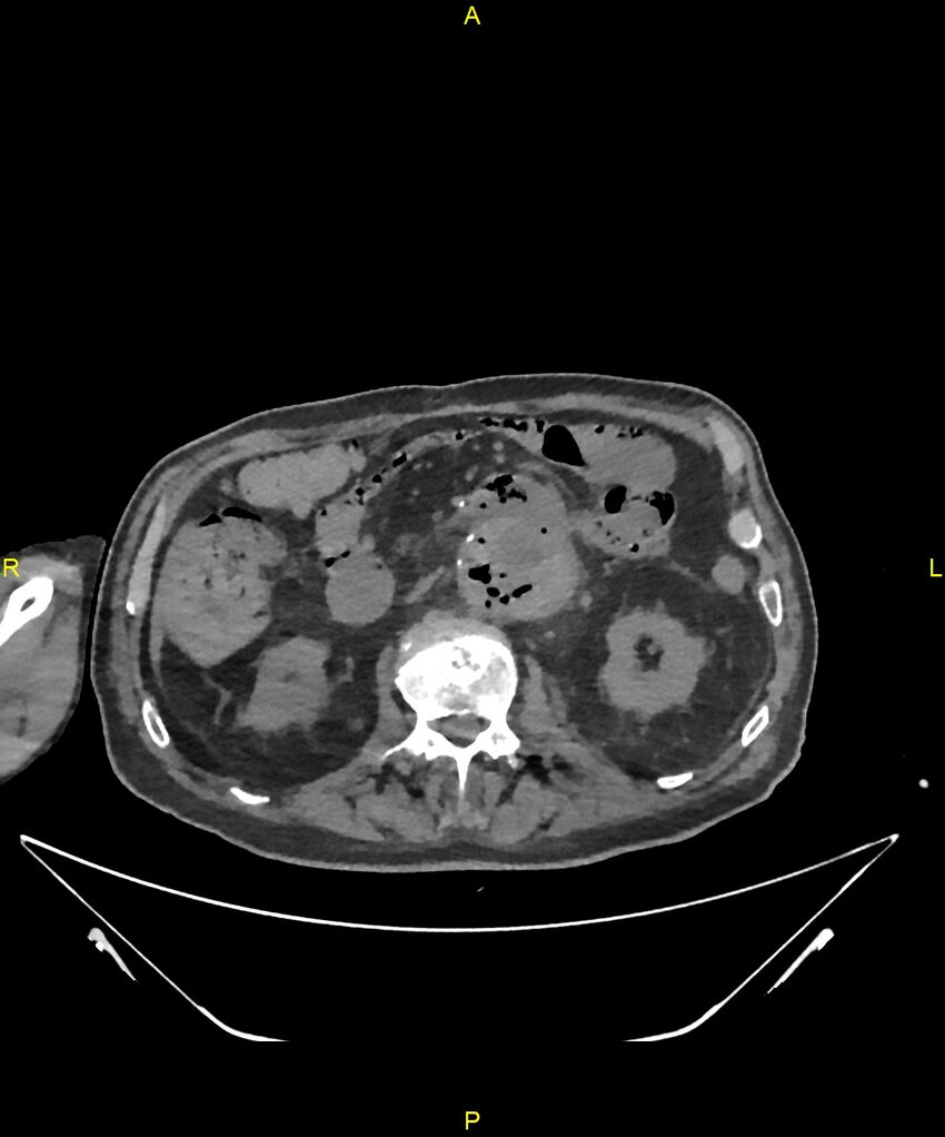 Aortoenteric fistula (Radiopaedia 84308-99603 Axial non-contrast 146).jpg