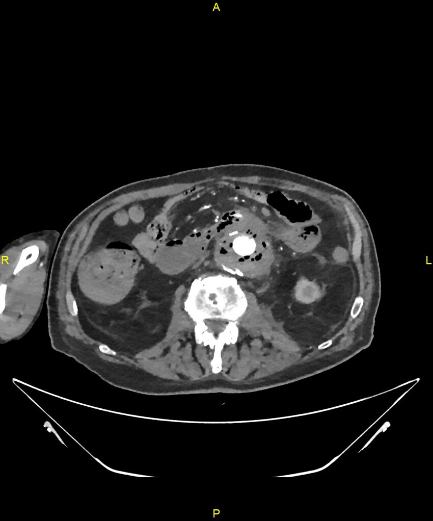 Aortoenteric fistula (Radiopaedia 84308-99603 B 169).jpg