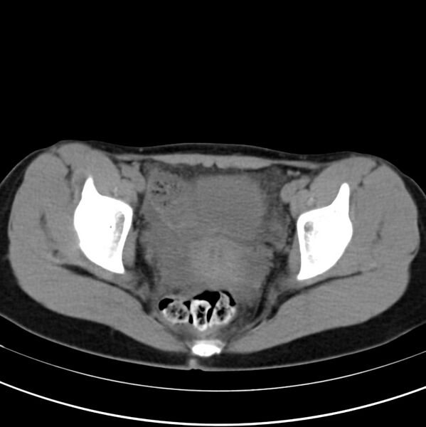 File:Appendicitis and incidental bicornuate uterus (Radiopaedia 22833-22853 Axial non-contrast 42).jpg