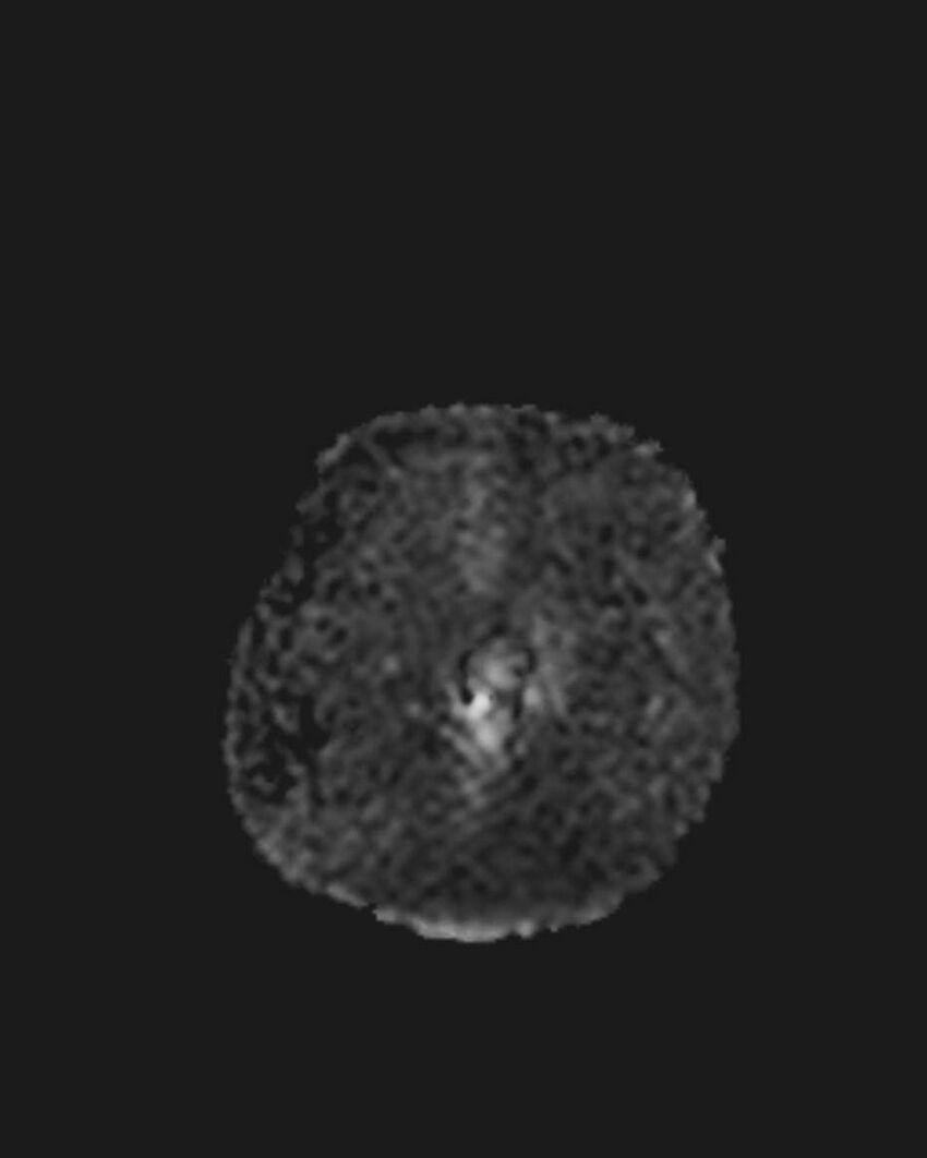 Appendicitis in gravida (MRI) (Radiopaedia 89433-106395 Coronal ADC 5).jpg