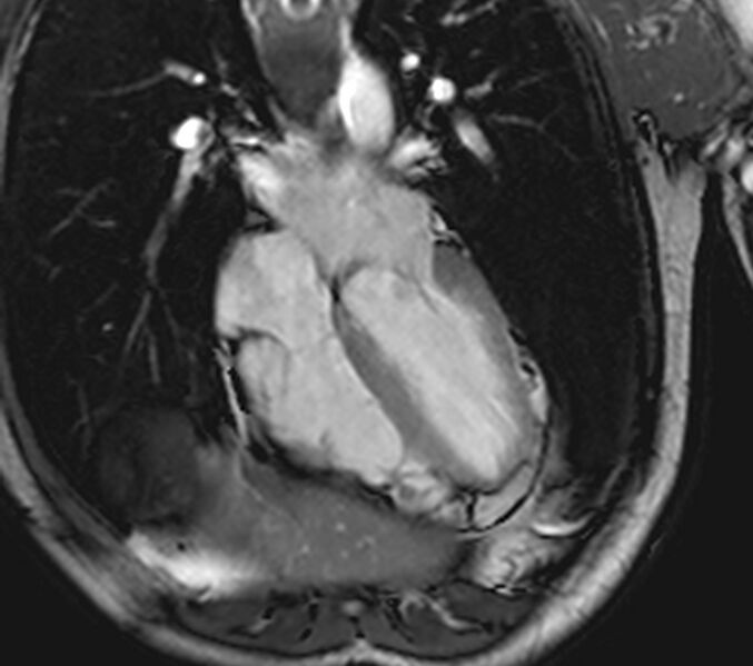 File:Arrhythmogenic right ventricular cardiomyopathy (Radiopaedia 39806-42237 D 77).jpg