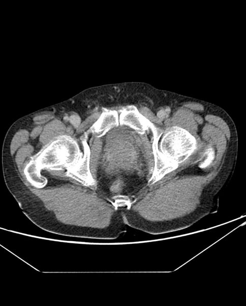 File:Arterial occlusive mesenteric ischemia (Radiopaedia 84641-100054 A 117).jpg