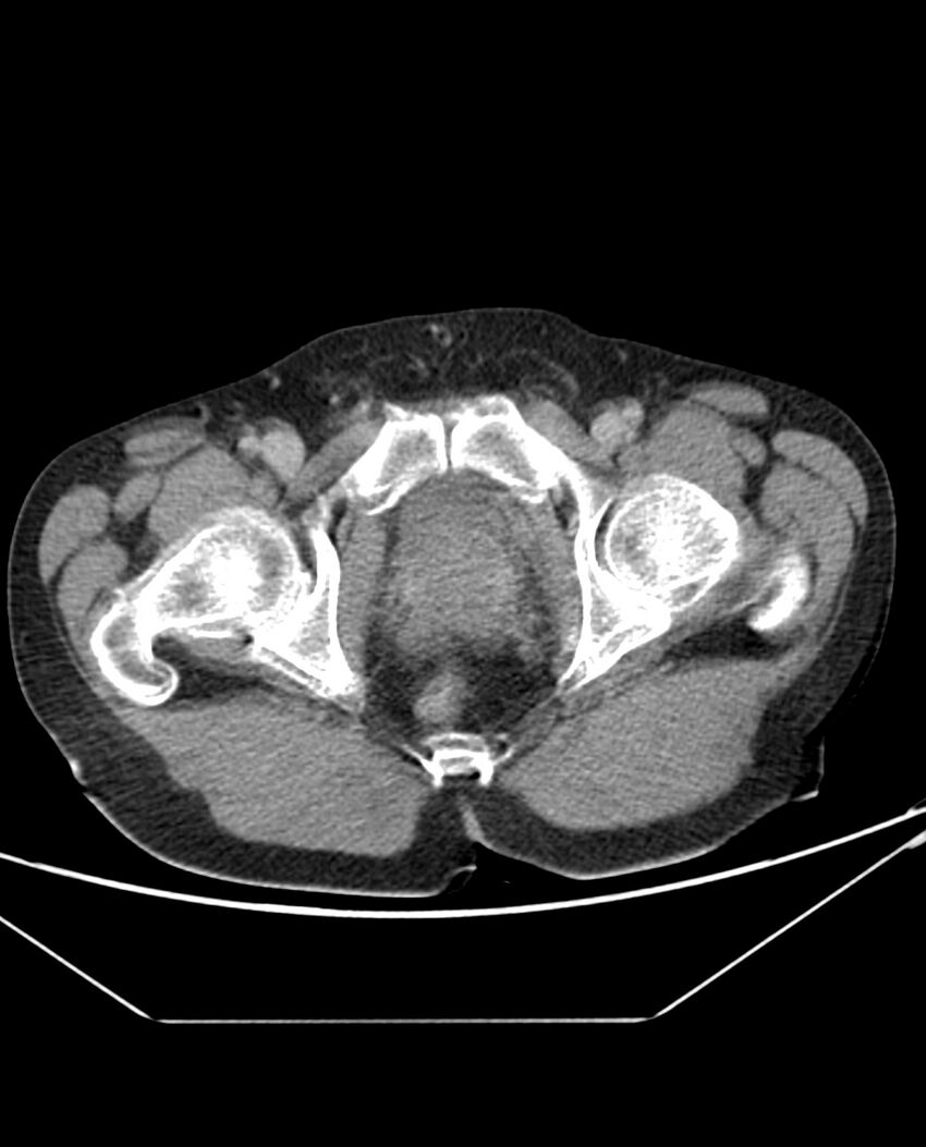 Arterial occlusive mesenteric ischemia (Radiopaedia 84641-100054 A 117).jpg