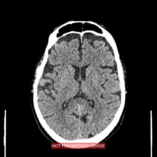 File:Artery of Percheron infarction (Radiopaedia 28679-28967 Axial non-contrast 66).jpg