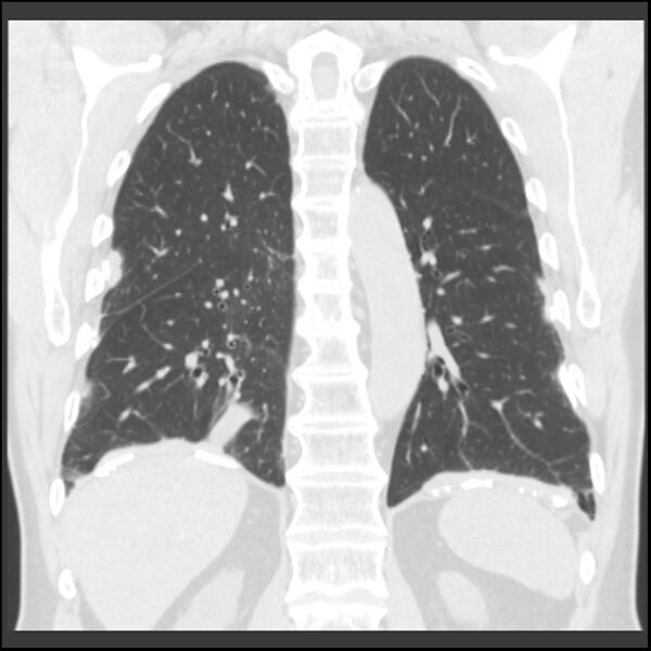 File:Asbestos-related pleural plaques (Radiopaedia 39069-41255 Coronal lung window 27).jpg