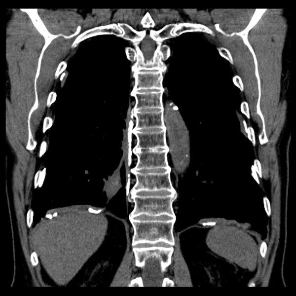 File:Asbestos-related pleural plaques (Radiopaedia 39069-41255 Coronal non-contrast 21).jpg