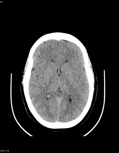 File:Astroblastoma (Radiopaedia 39792-42216 Axial non-contrast 25).jpg