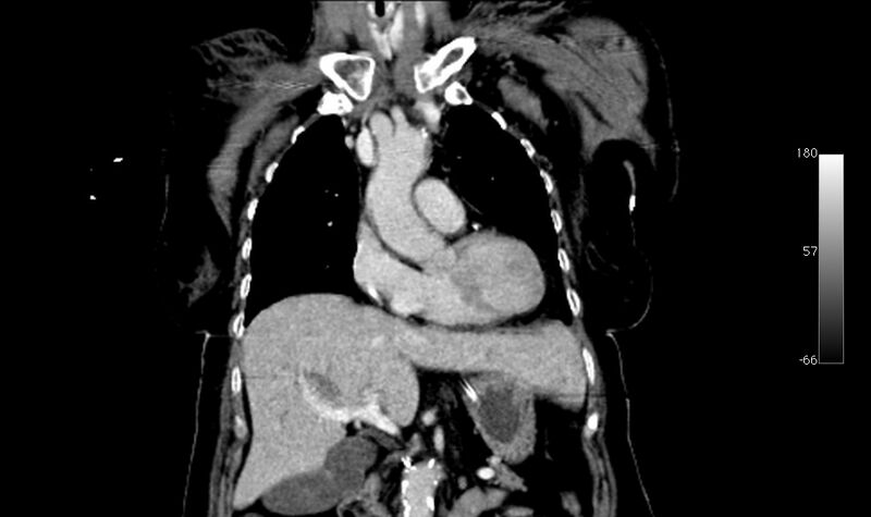 File:Atypical dissection of the thoracic aorta (Radiopaedia 10975-78320 B 7).jpg