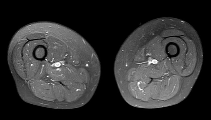 Atypical lipomatous tumor - thigh (Radiopaedia 68975-78734 Axial PD fat sat 45).jpg