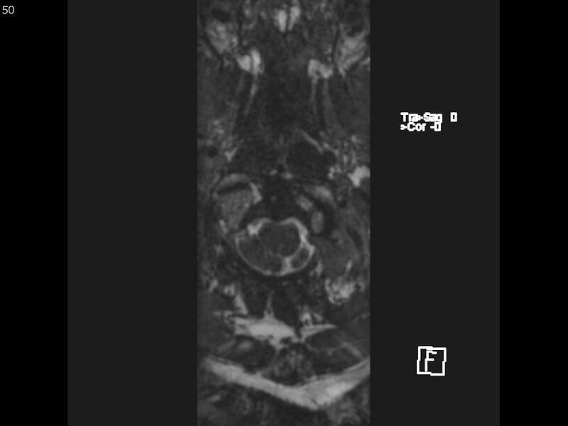 File:Atypical meningioma - intraosseous (Radiopaedia 64915-74572 Axial CISS 50).jpg