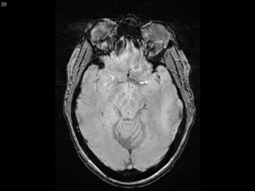 Atypical meningioma - intraosseous (Radiopaedia 64915-74572 Axial SWI 39).jpg