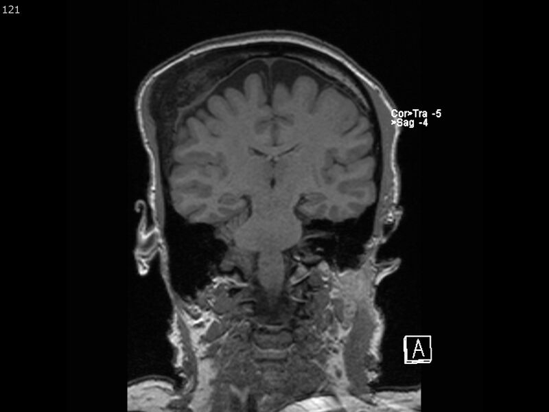 File:Atypical meningioma - intraosseous (Radiopaedia 64915-74572 Coronal T1 121).jpg