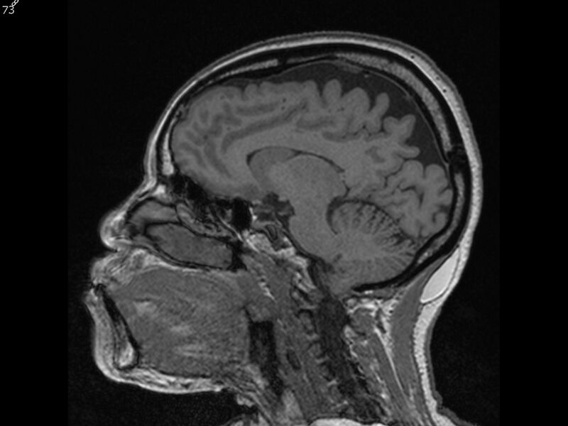 File:Atypical meningioma - intraosseous (Radiopaedia 64915-74572 Sagittal T1 73).jpg