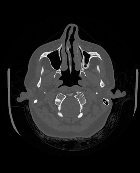 File:Automastoidectomy with labyrinthine fistula (Radiopaedia 84143-99411 Axial non-contrast 53).jpg