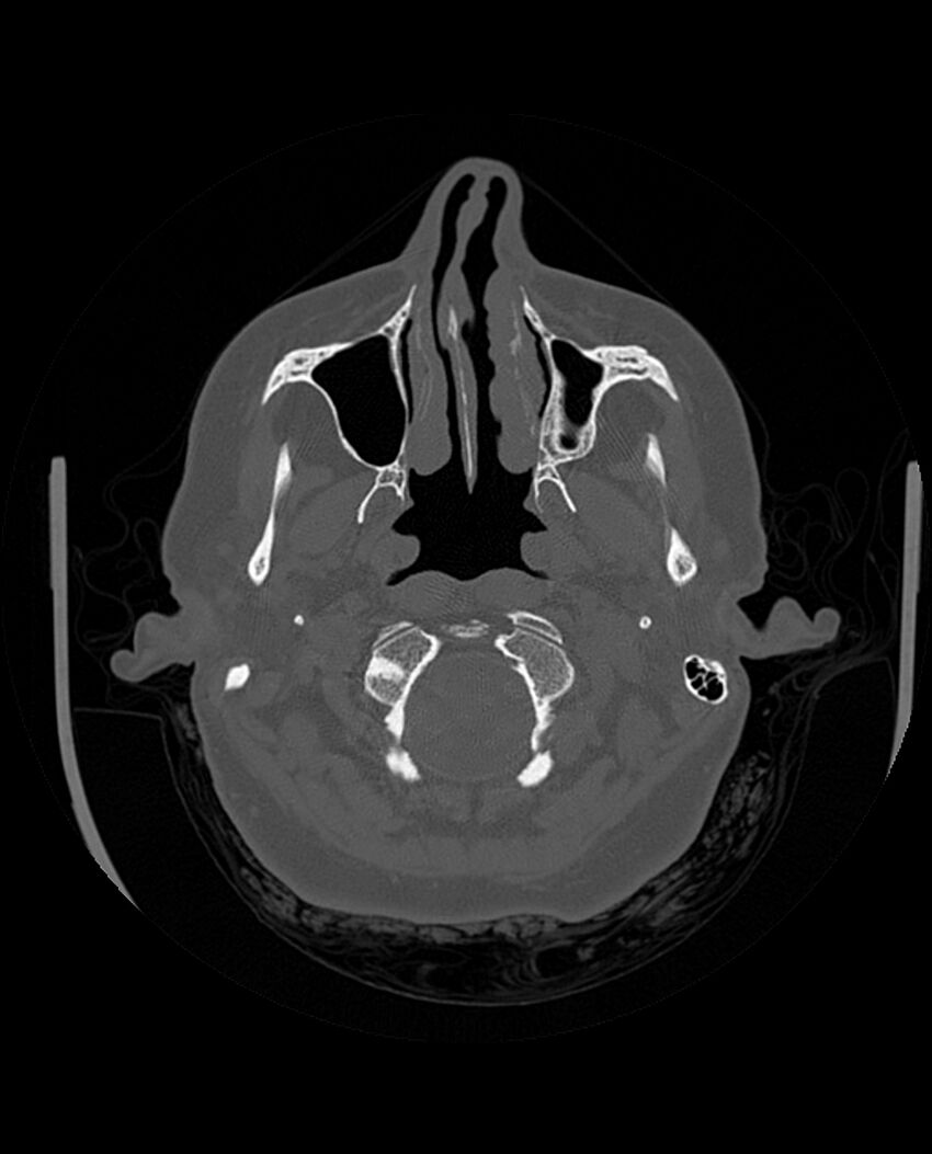 Automastoidectomy with labyrinthine fistula (Radiopaedia 84143-99411 Axial non-contrast 53).jpg