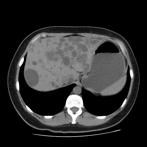File:Autosomal dominant polycystic kidney disease (Radiopaedia 23061-23093 Axial non-contrast 11).jpg