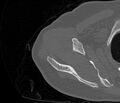 Avulsion fracture - greater tuberosity of humerus (Radiopaedia 71216-81514 Axial bone window 22).jpg