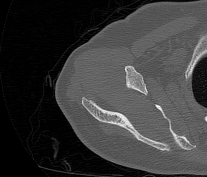 File:Avulsion fracture - greater tuberosity of humerus (Radiopaedia 71216-81514 Axial bone window 22).jpg
