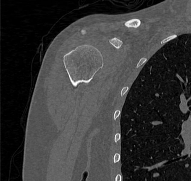 File:Avulsion fracture - greater tuberosity of humerus (Radiopaedia 71216-81514 Coronal bone window 15).jpg