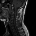 Axis fracture - MRI (Radiopaedia 71925-82375 Sagittal T1 4).jpg