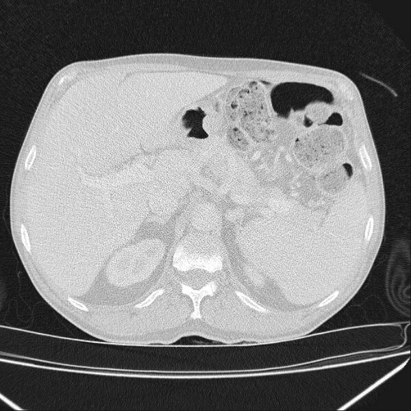 File:Azygos lobe (Radiopaedia 38259-40275 Axial lung window 85).jpg