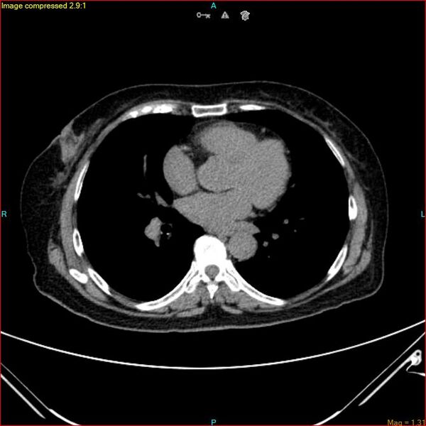 File:Azygos vein aneurysm (Radiopaedia 77824-90130 A 36).jpg
