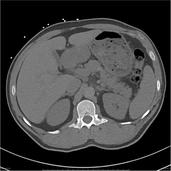 File:Azygos venous system anatomy (CT pulmonary angiography) (Radiopaedia 25928-26077 Axial C+ CTPA 96).jpg