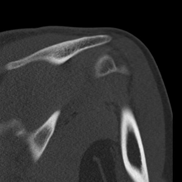 File:Bankart lesion (Radiopaedia 22771-22798 Coronal bone window 32).jpg