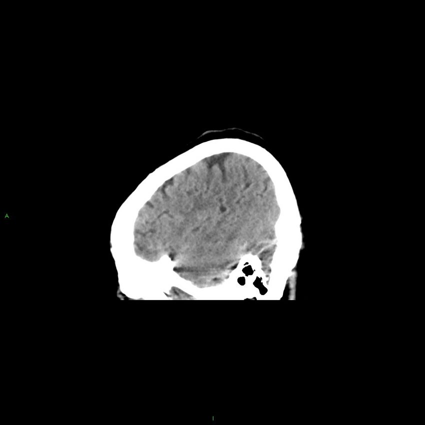 Basal ganglia hemorrhage (Radiopaedia 58349-65472 C 9).jpg
