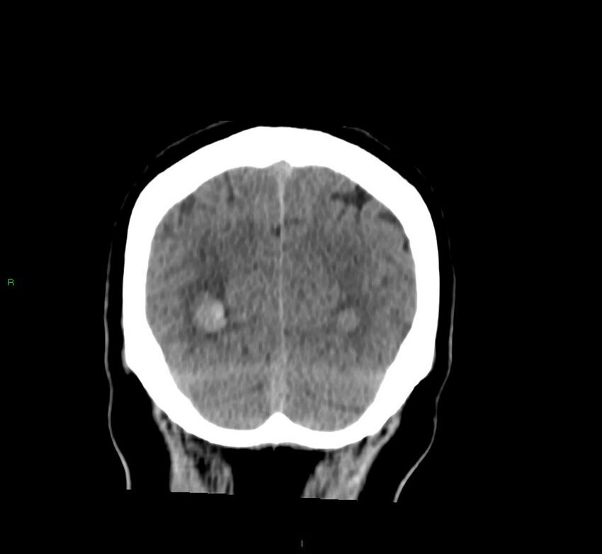Basal ganglia hemorrhage (Radiopaedia 58763-65985 Coronal non-contrast 18).jpg