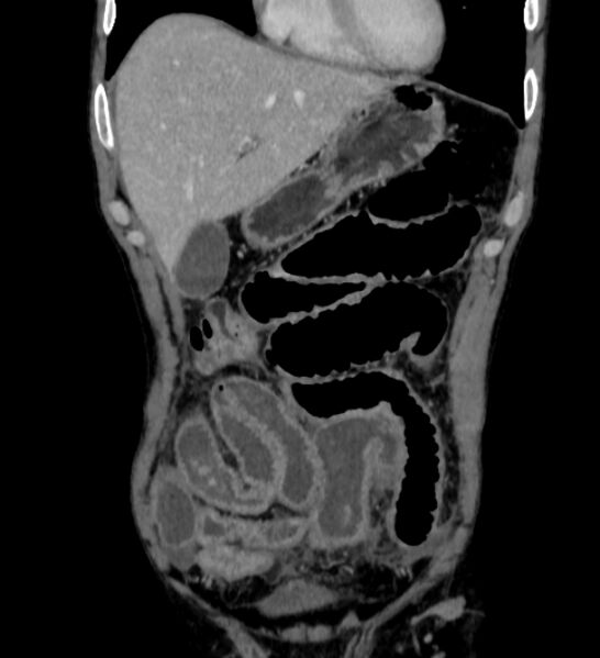 File:Behçet's disease- abdominal vasculitis (Radiopaedia 55955-62570 B 9).jpg