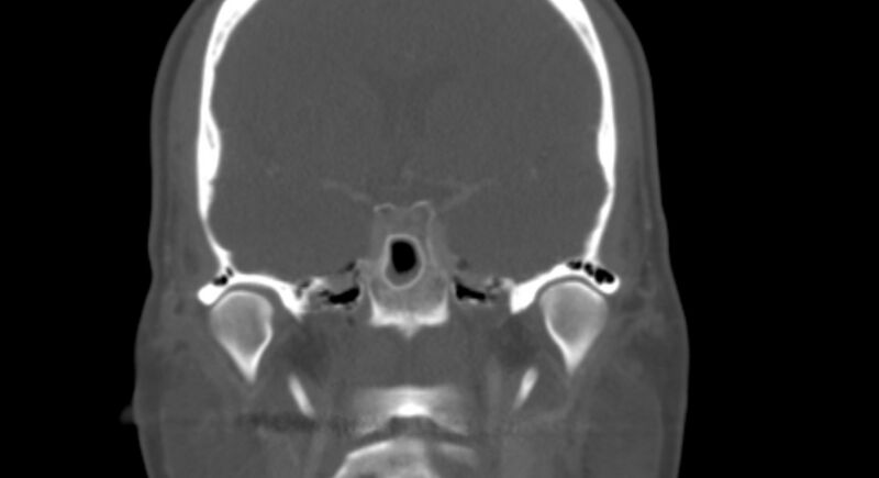 File:Benign mixed salivary tumor of the parotid gland (Radiopaedia 35261-36792 Coronal bone window 17).jpg
